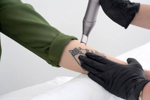 Beautician using laser device to remove an unwanted tattoo