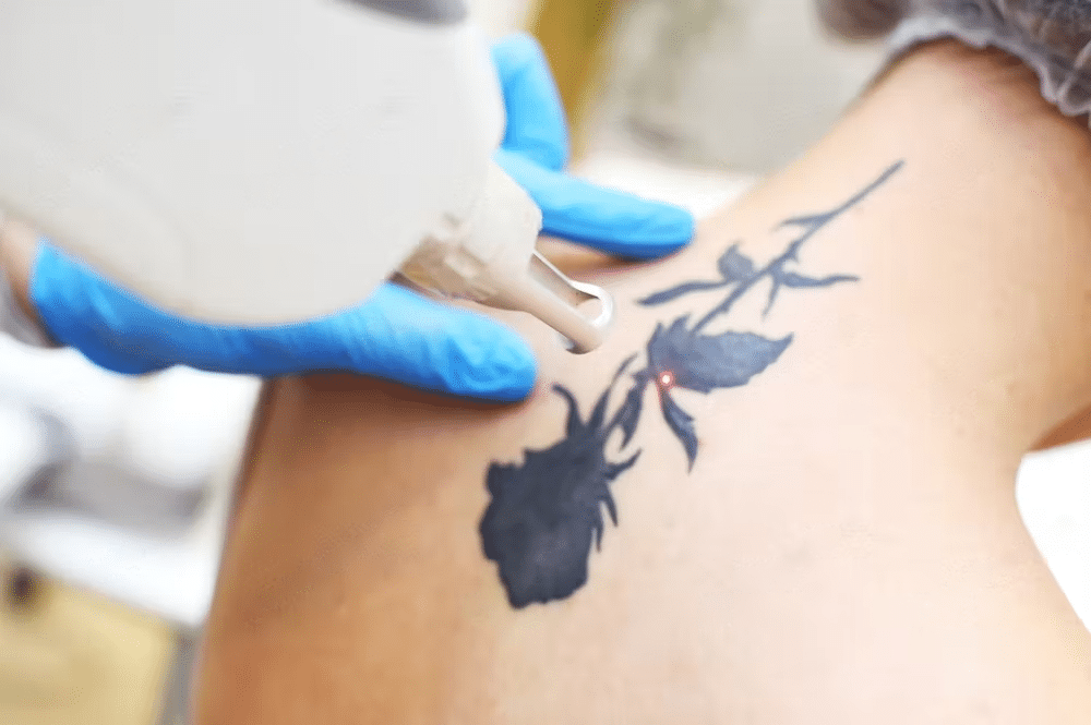 Tattoo Removal Treatments